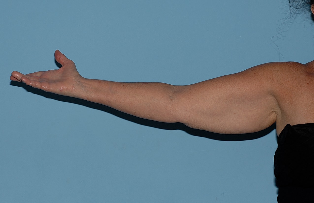 Arm Lift Before & After