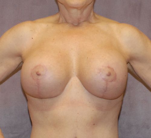 Breast Corrections And Revisions Before & After