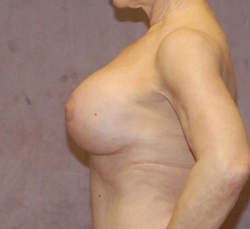 Breast Corrections And Revisions Before & After