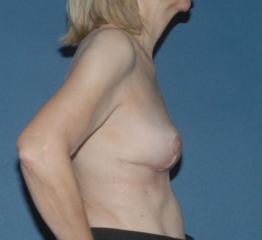 Breast Corrections And Revisions Before & After