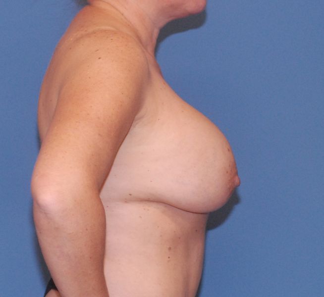 Breast Corrections And Revisions Before & After