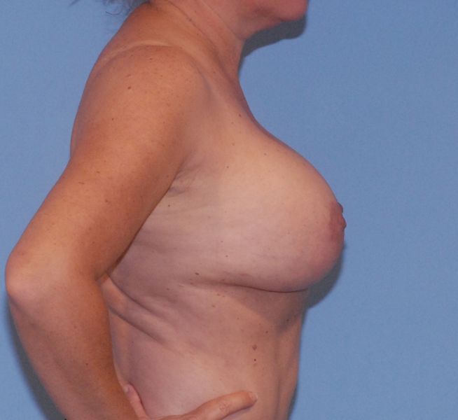 Breast Corrections And Revisions Before & After