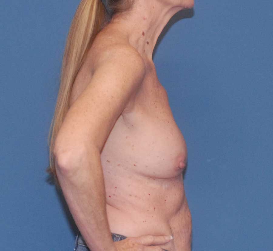 Breast Corrections And Revisions Before & After