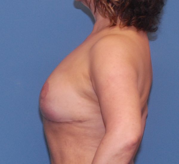 Breast Corrections And Revisions Before & After