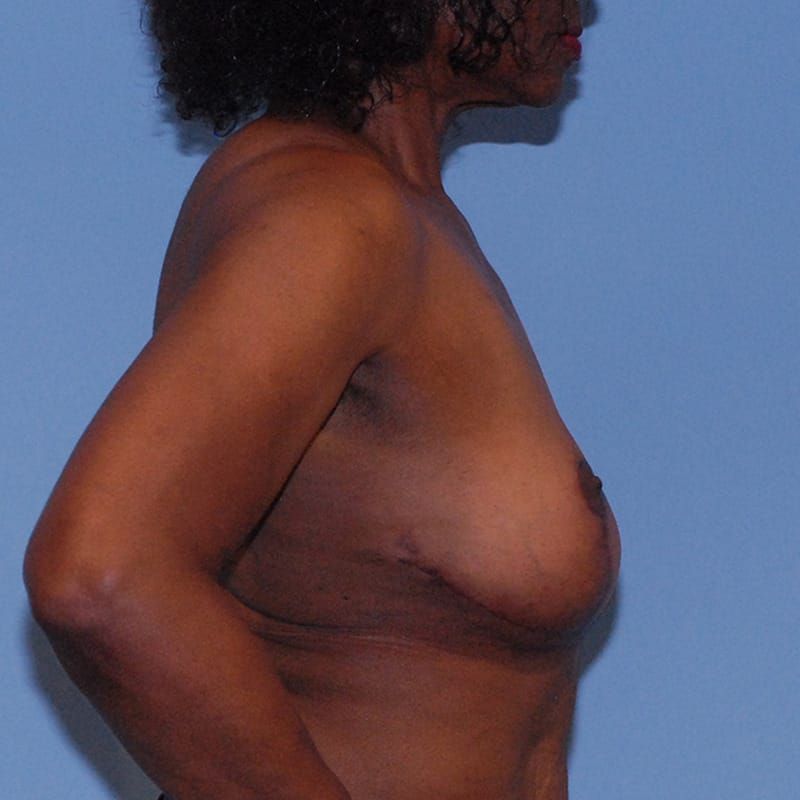 Breast Corrections And Revisions Before & After