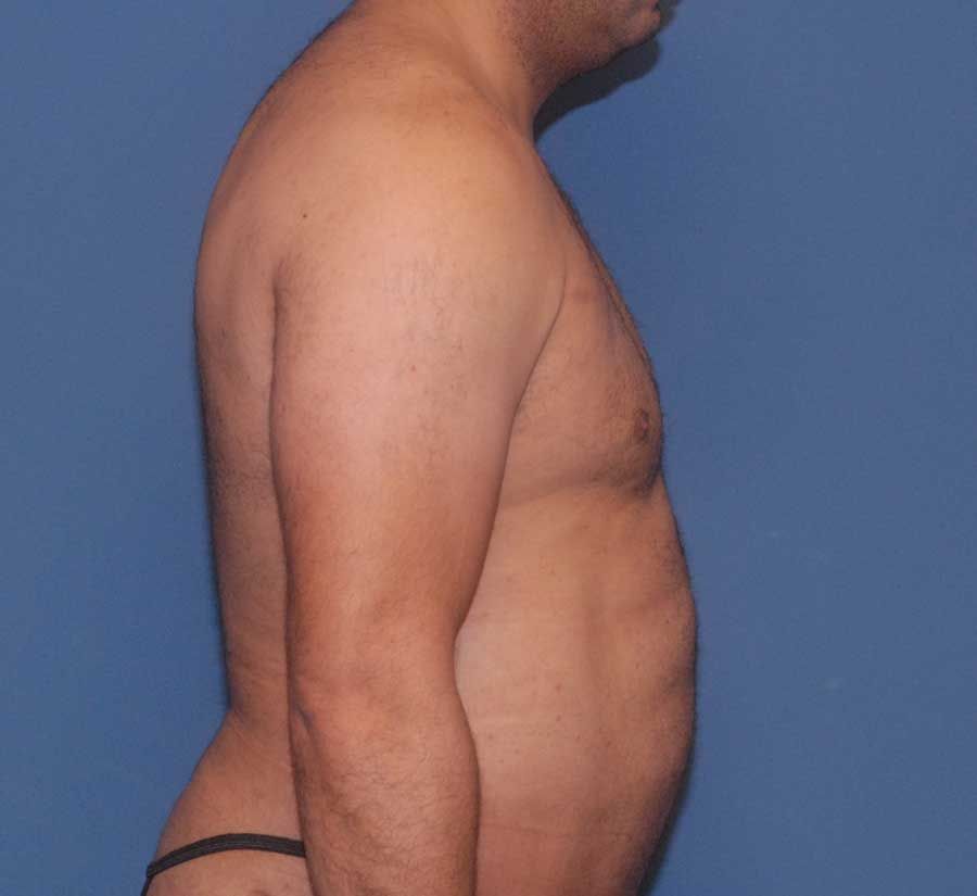Gynecomastia Before & After