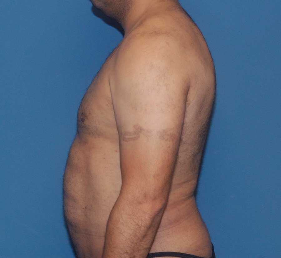 Gynecomastia Before & After