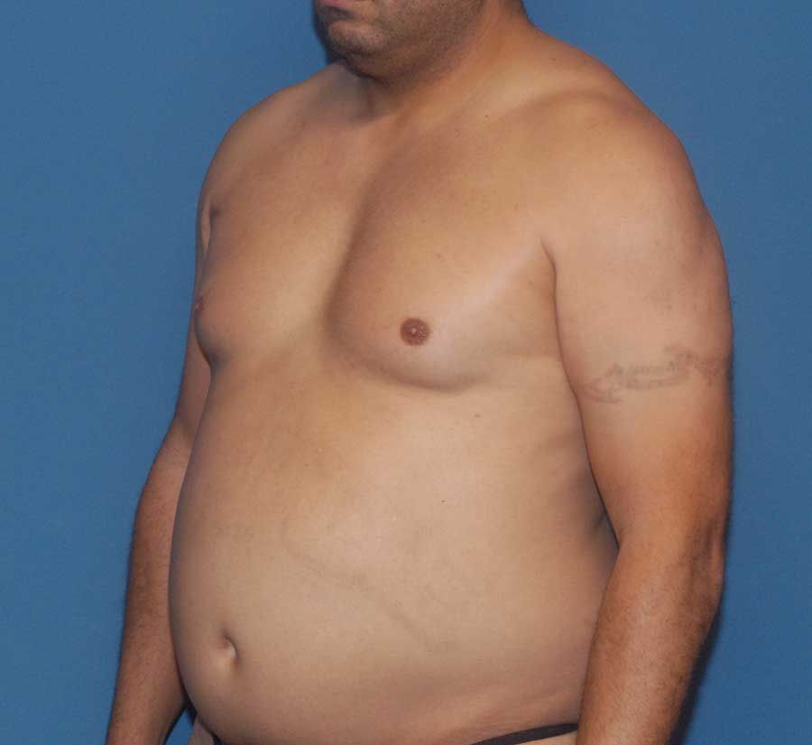 Gynecomastia Before & After