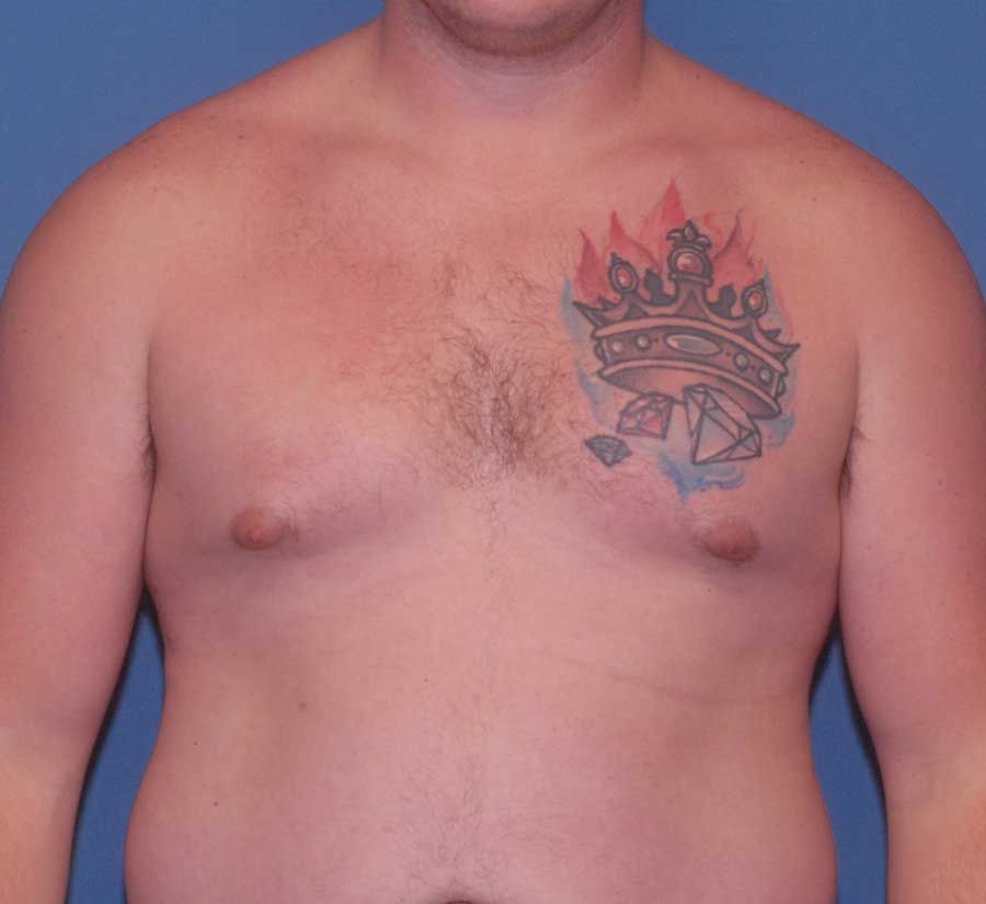 Gynecomastia Before & After