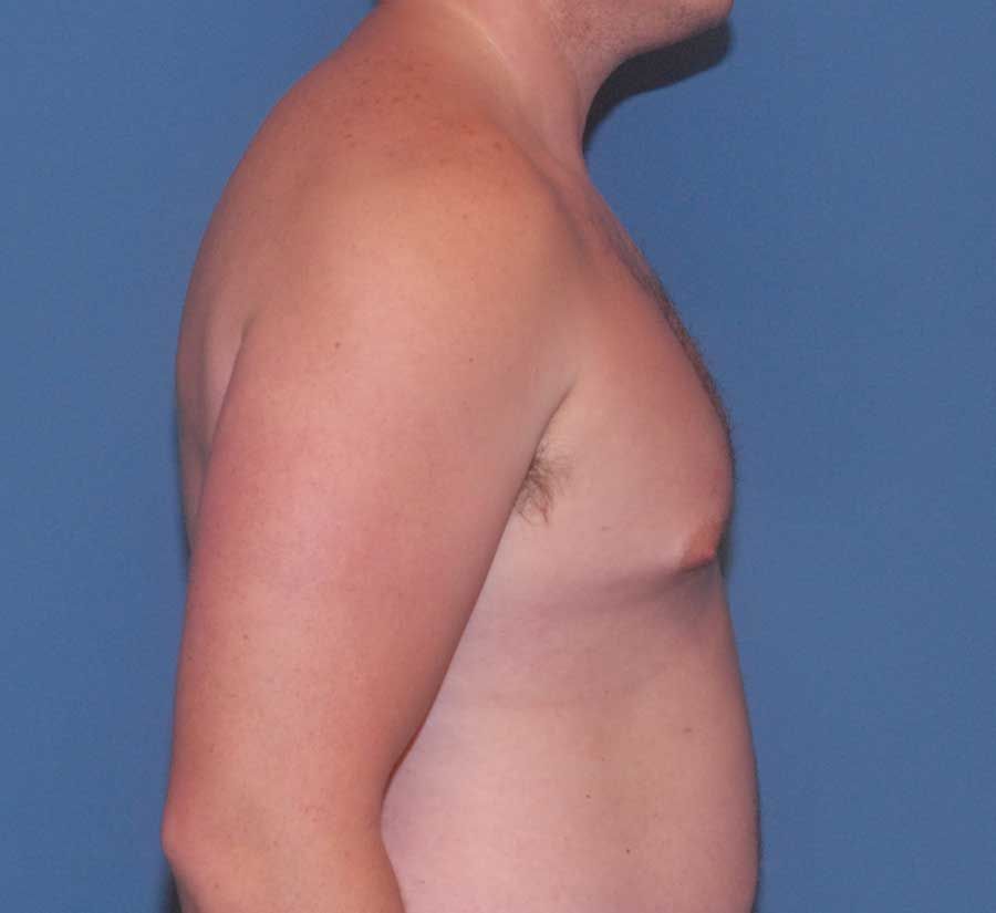 Gynecomastia Before & After