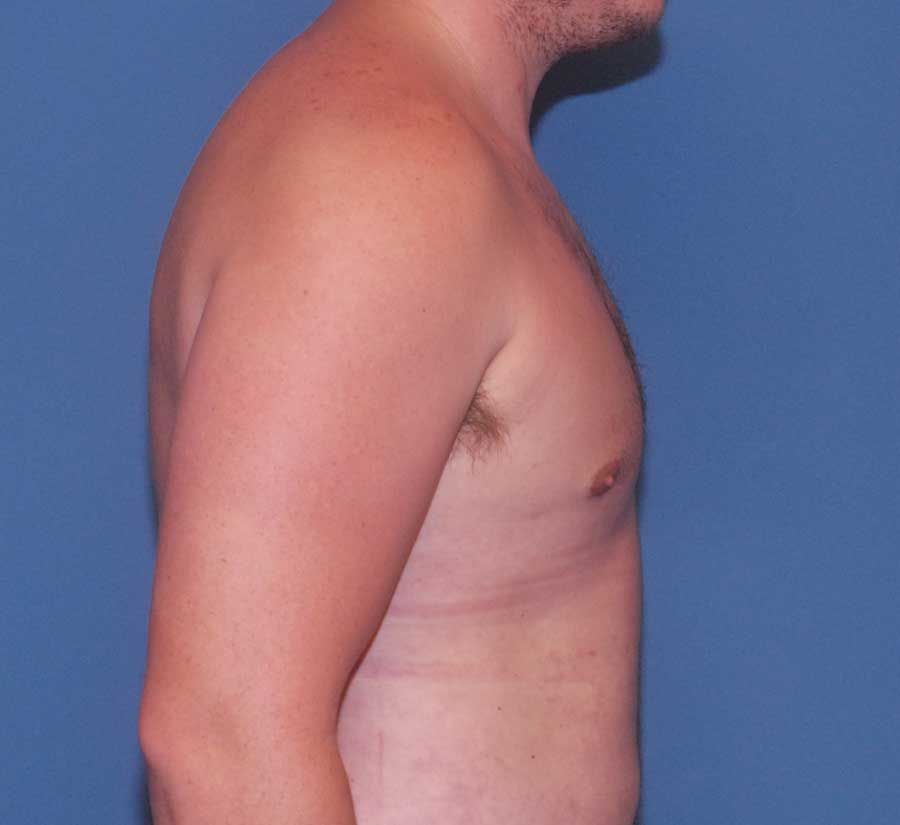 Gynecomastia Before & After