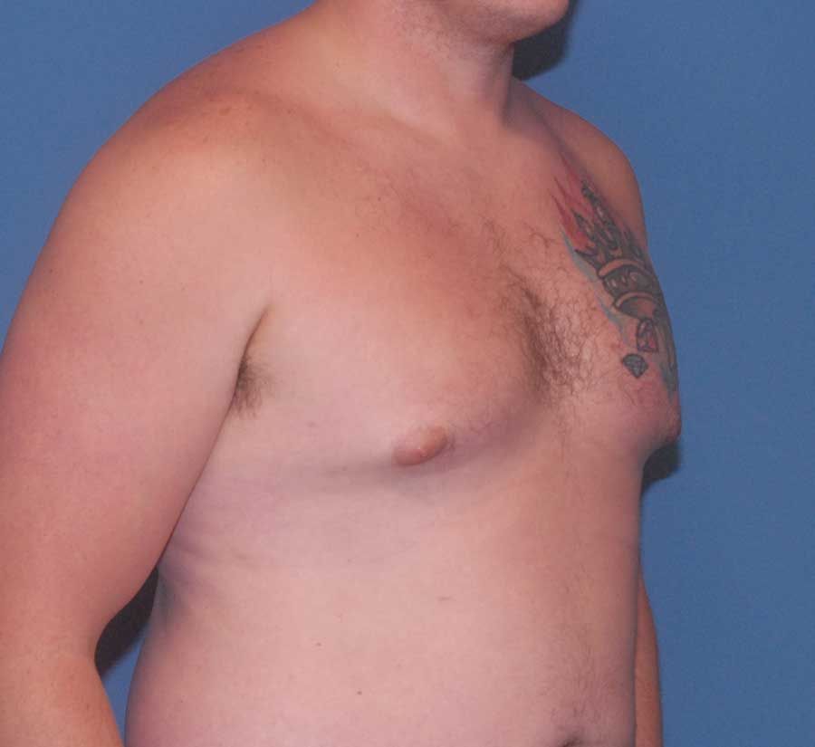 Gynecomastia Before & After