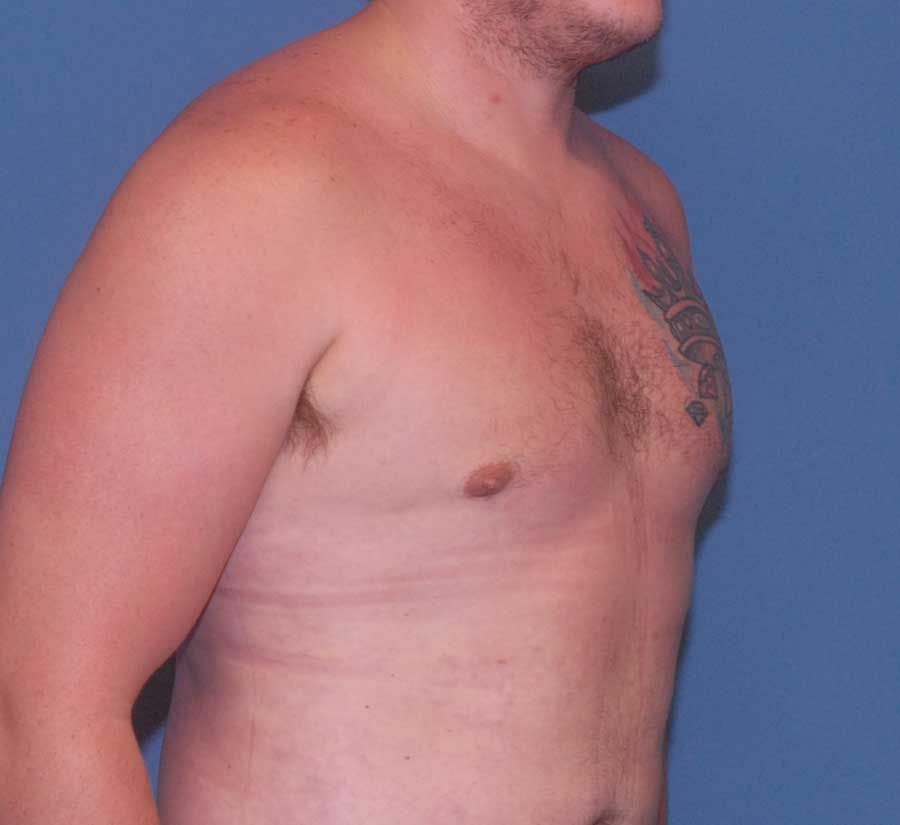 Gynecomastia Before & After
