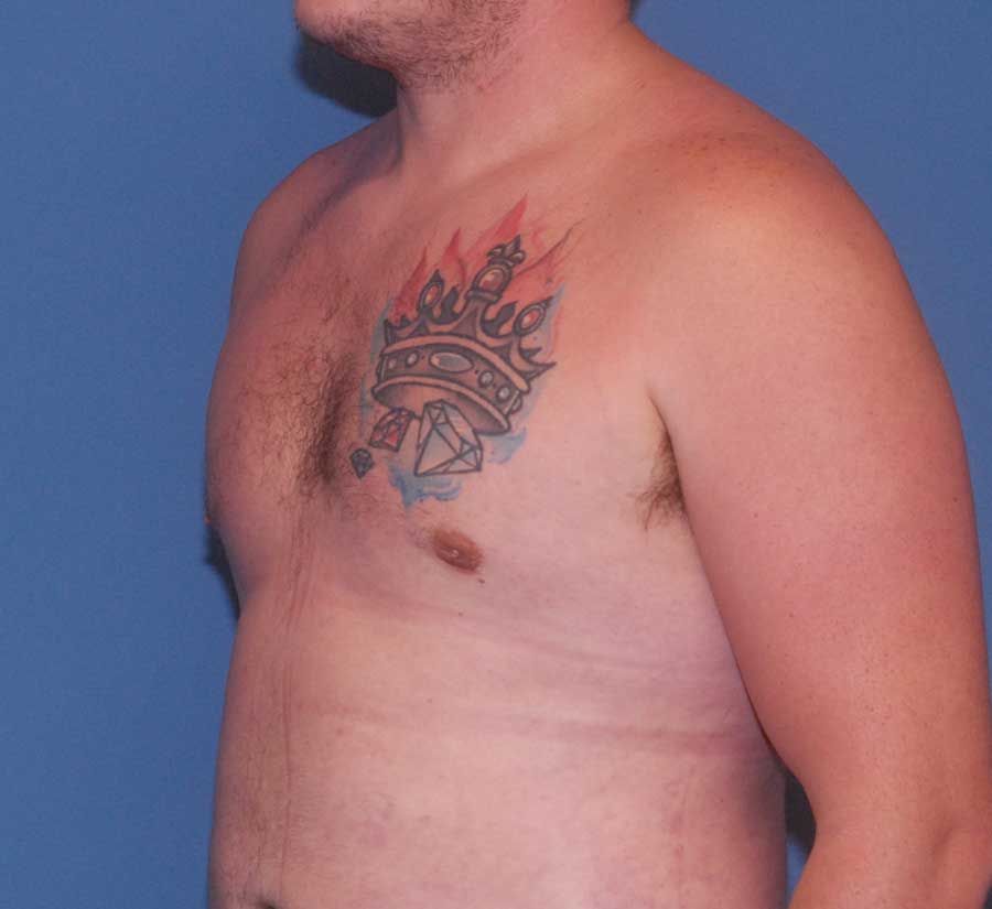 Gynecomastia Before & After