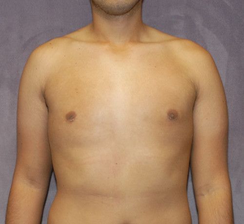 Gynecomastia Before & After