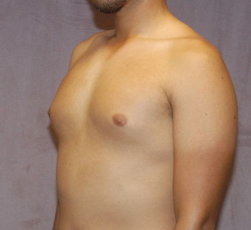 Gynecomastia Before & After
