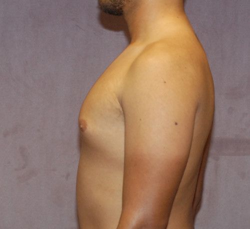 Gynecomastia Before & After