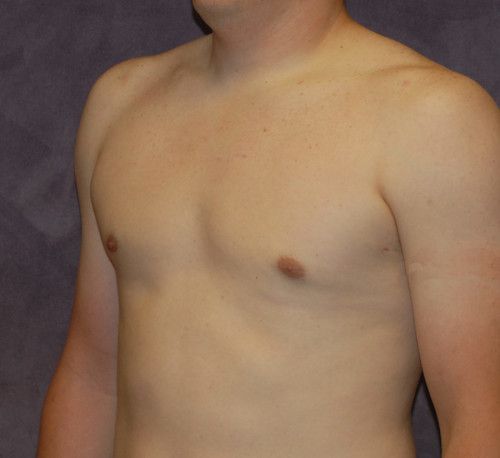 Gynecomastia Before & After