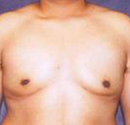 Gynecomastia Before & After