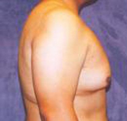 Gynecomastia Before & After