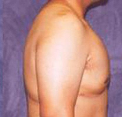 Gynecomastia Before & After