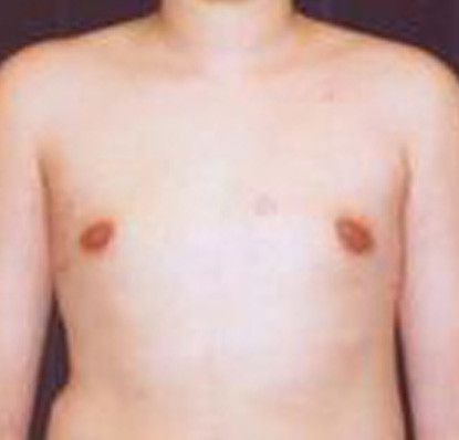 Gynecomastia Before & After