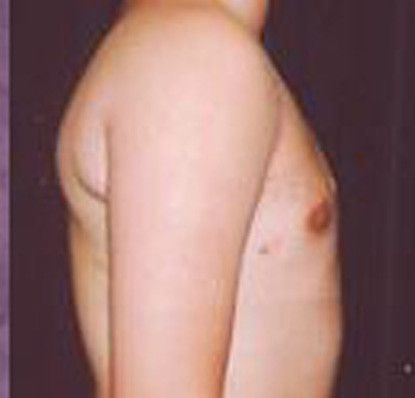 Gynecomastia Before & After