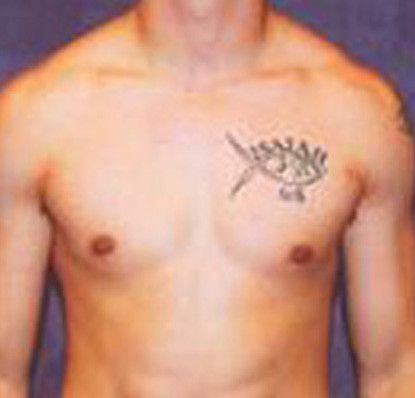 Gynecomastia Before & After