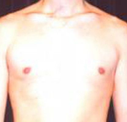 Gynecomastia Before & After