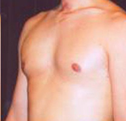 Gynecomastia Before & After
