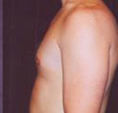 Gynecomastia Before & After