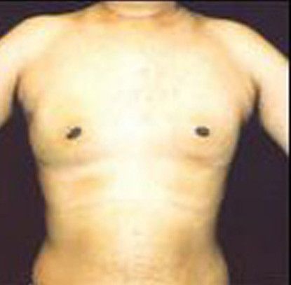 Gynecomastia Before & After