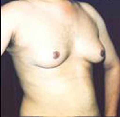 Gynecomastia Before & After