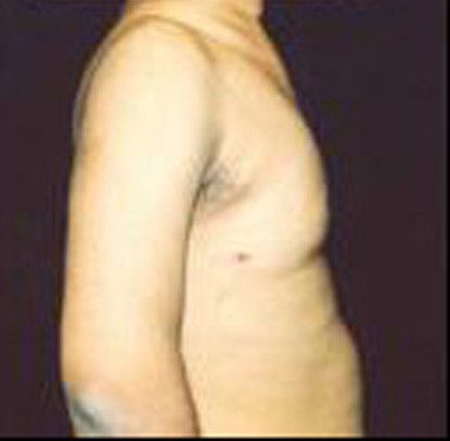 Gynecomastia Before & After