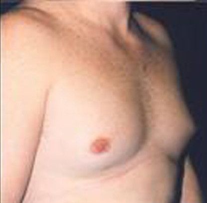 Gynecomastia Before & After