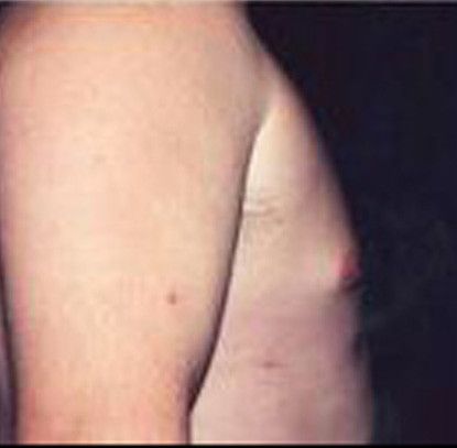 Gynecomastia Before & After