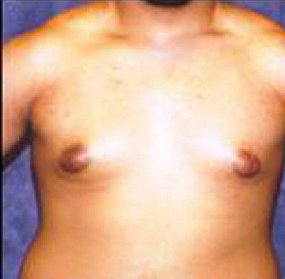 Gynecomastia Before & After