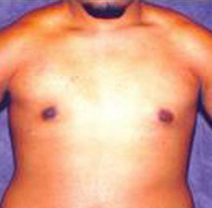 Gynecomastia Before & After