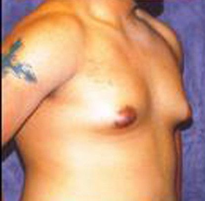 Gynecomastia Before & After