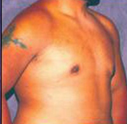 Gynecomastia Before & After
