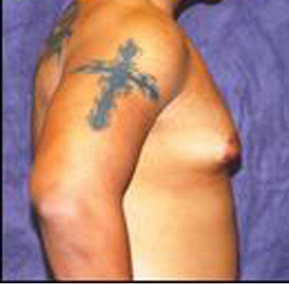 Gynecomastia Before & After