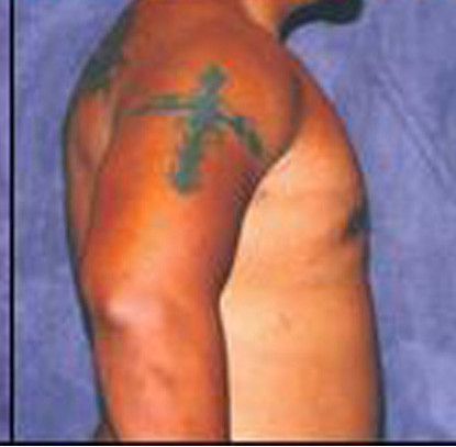 Gynecomastia Before & After