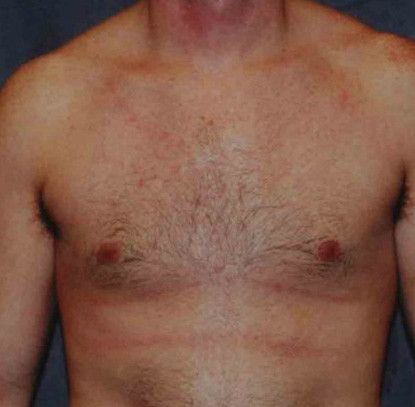 Gynecomastia Before & After