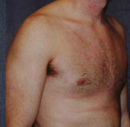 Gynecomastia Before & After