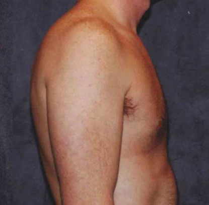 Gynecomastia Before & After