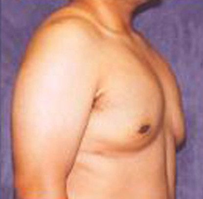 Gynecomastia Before & After