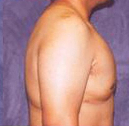 Gynecomastia Before & After
