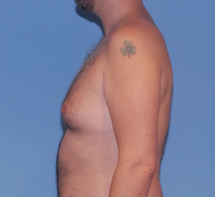 Gynecomastia Before & After