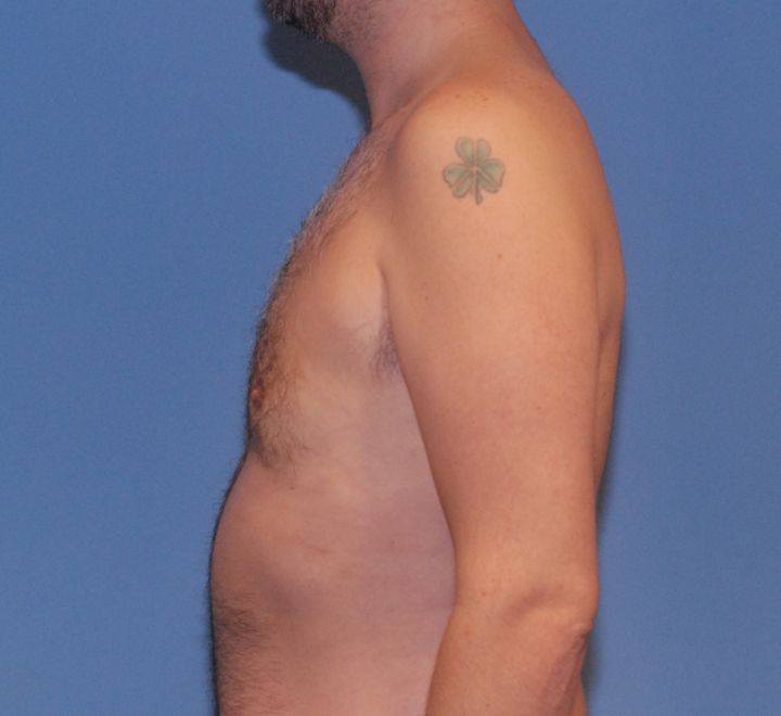 Gynecomastia Before & After