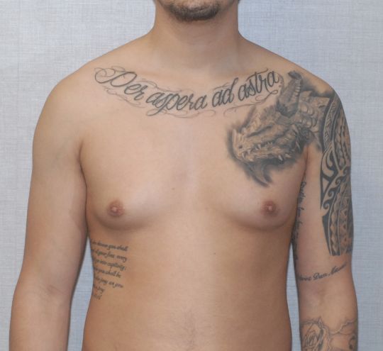 Gynecomastia Before & After